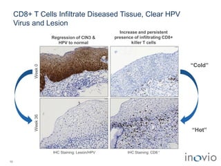 CD8+ T Cells Infiltrate Diseased Tissue, Clear HPV
Virus and Lesion
10
Week0
IHC Staining: Lesion/HPV
Week36
IHC Staining: CD8 +
Regression of CIN3 &
HPV to normal
Increase and persistent
presence of infiltrating CD8+
killer T cells
“Cold”
“Hot”
 
