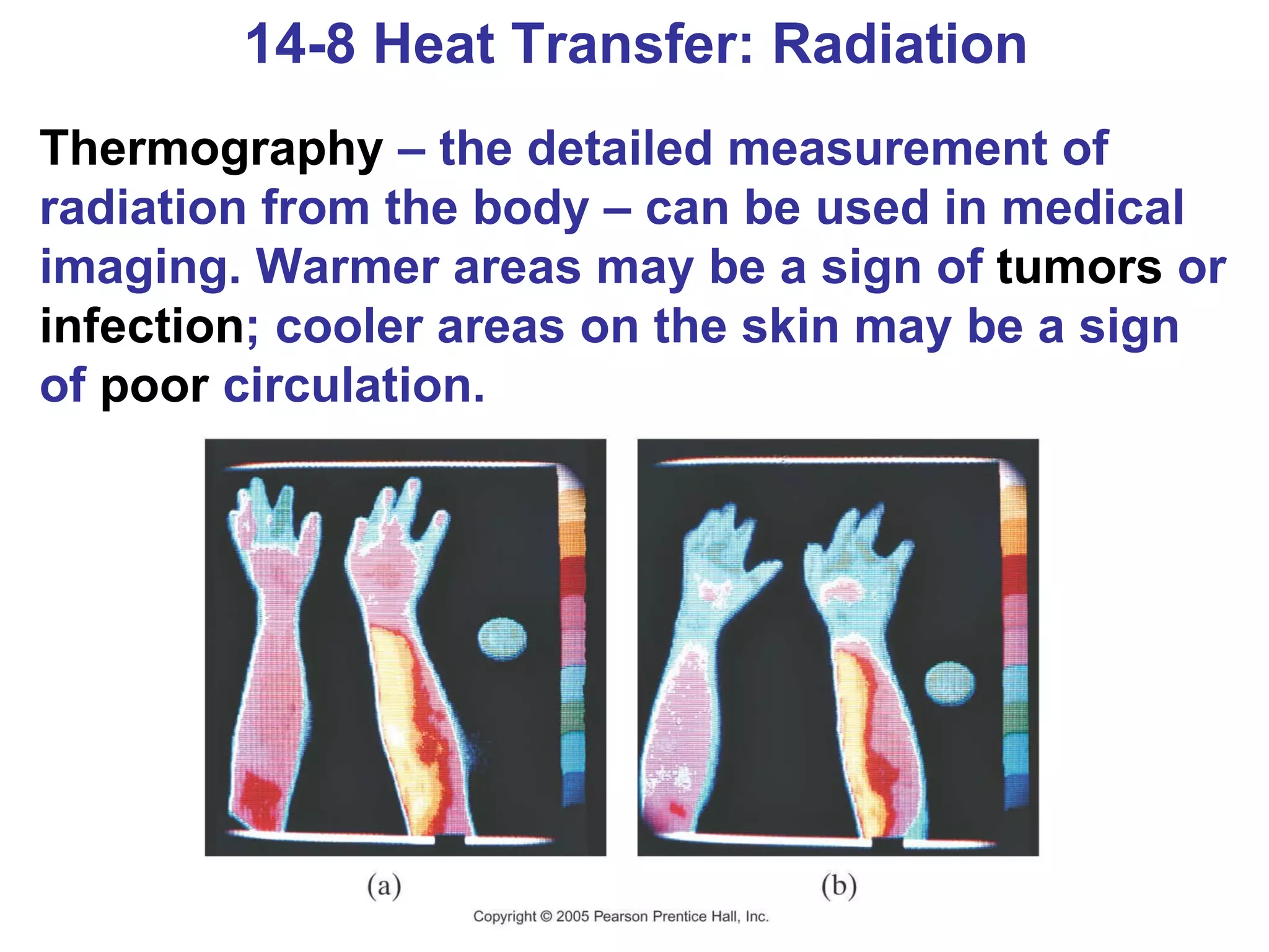 14-8 Heat Transfer: Radiation Thermography  – the detailed measurement of radiation from the body – can be used in medical imaging. Warmer areas may be a sign of  tumors  or  infection ; cooler areas on the skin may be a sign of  poor  circulation. 