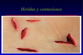 Heridas y contusiones

 