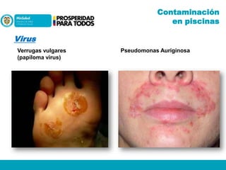 Contaminación
en piscinas

Virus
Verrugas vulgares
(papiloma virus)

Pseudomonas Auriginosa

 