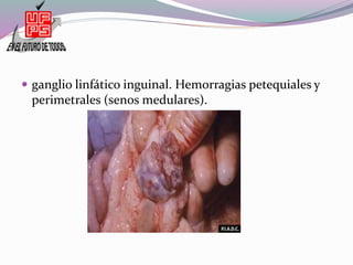  ganglio linfático inguinal. Hemorragias petequiales y
perimetrales (senos medulares).
 