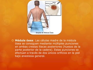  Médula ósea: Las células madre de la médula
ósea se consiguen mediante múltiples punciones
en ambas crestas iliacas posteriores (huesos de la
parte posterior de la cadera). Estas punciones se
efectúan a través de dos únicos orificios en la piel
bajo anestesia general.
 