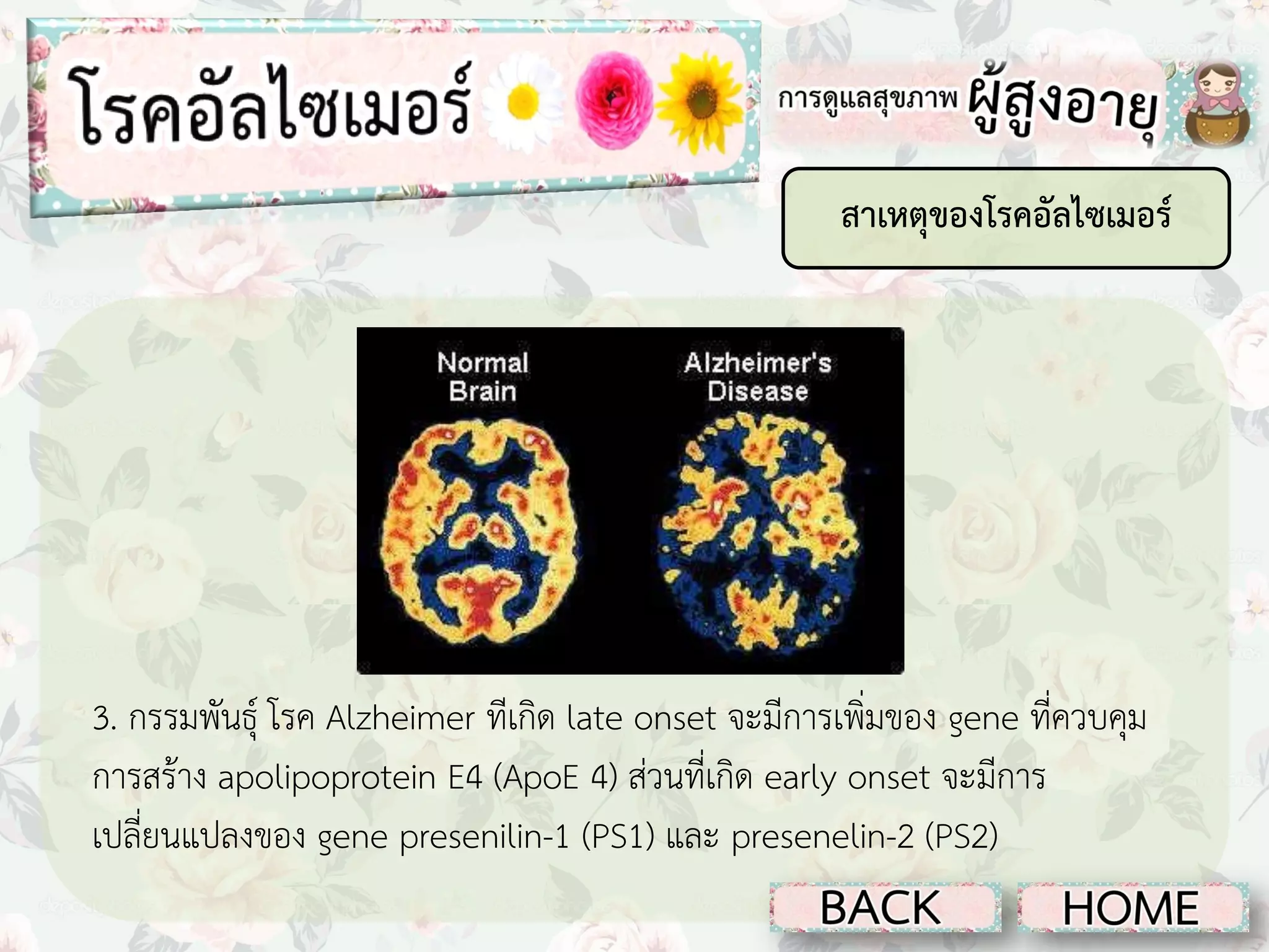 สาเหตุของโรคอัลไซเมอร์

3. กรรมพันธุ์ โรค Alzheimer ทีเกิด late onset จะมีการเพิ่มของ gene ที่ควบคุม
การสร้าง apolipoprotein E4 (ApoE 4) ส่วนที่เกิด early onset จะมีการ
เปลี่ยนแปลงของ gene presenilin-1 (PS1) และ presenelin-2 (PS2)

 