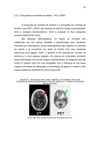 25
2.3.2 Tomografia por emissão de pósitron – PET e SPET
A tomografia por emissão de pósitron e a tomografia por emissão de
pósitron único (PET e SPET) são técnicas da medicina nuclear que possibilitam
tanto a avaliação neuroreceptores, como a avaliação do fluxo sanguíneo
cerebral (CARVALHO, 2012).
São utilizados radiotraçadores, um líquido de contraste com
substâncias que tem grande afinidade e especificidade para receptores
marcados por radioisótopos. Esses radiotraçadores são injetados no indivíduo
em estudo e se concentram nas áreas do cérebro com mais receptores
disponíveis para ligação. Então, o aparelho emite radiação por emissão de
pósitrons e o local aparece realçado. Um sistema de computador reconstrói
essas informações na forma de imagens tridimensionais. As imagens finais são
cortes no cérebro como em uma tomografia, com a diferença de que essas
imagens são mapas de distribuição e concentração do ligante no cérebro e não
mapas anatômicos (CARVALHO, 2012) (Figura 05).
FIGURA 05 – IMAGEM DE UMA LESÃO TUMORAL DO CÉREBRO VISTA POR
TOMOGRAFIA SIMPLES (ESQUERDA) E POR PET (DIREITA). O TUMOR É APONTADO
PELAS FLECHAS.
Fonte: http://www.cerebromente.org.br/n01/pet/pet_port.htm.
 