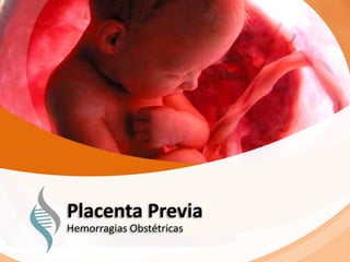 Placenta Previa
Hemorragias Obstétricas
 