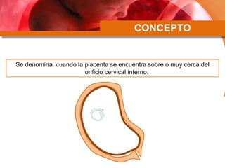 CONCEPTO
Se denomina cuando la placenta se encuentra sobre o muy cerca del
orificio cervical interno.
 