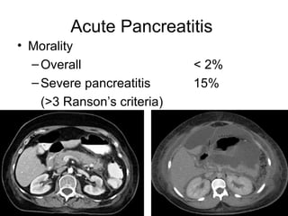 Acute Pancreatitis Morality Overall  < 2% Severe pancreatitis   15% (>3 Ranson’s criteria) 