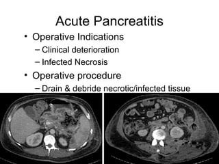 Acute Pancreatitis Operative Indications Clinical deterioration  Infected Necrosis Operative procedure Drain & debride necrotic/infected tissue 
