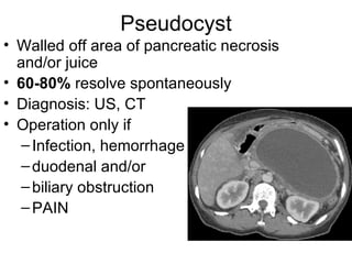 Pseudocyst Walled off area of pancreatic necrosis and/or juice 60-80%  resolve spontaneously Diagnosis: US, CT Operation only if Infection, hemorrhage  duodenal and/or  biliary obstruction  PAIN 