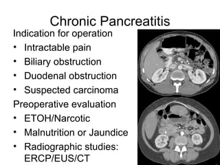 Chronic Pancreatitis   Indication for operation Intractable pain Biliary obstruction Duodenal obstruction Suspected carcinoma Preoperative evaluation ETOH/Narcotic Malnutrition or Jaundice Radiographic studies: ERCP/EUS/CT 