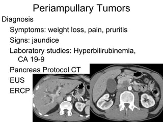 Periampullary Tumors Diagnosis Symptoms: weight loss, pain, pruritis Signs: jaundice Laboratory studies: Hyperbilirubinemia, CA 19-9 Pancreas Protocol CT EUS ERCP 
