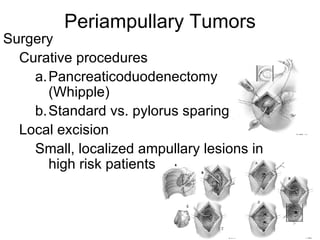 Periampullary Tumors Surgery Curative procedures Pancreaticoduodenectomy (Whipple) Standard vs. pylorus sparing Local excision Small, localized ampullary lesions in high risk patients 
