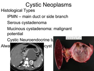 Cystic Neoplasms Histological Types IPMN – main duct or side branch Serous cystadenoma Mucinous cystadenoma: malignant potential Cystic Neuroendocrine tumor Always rule out pseudocyst 