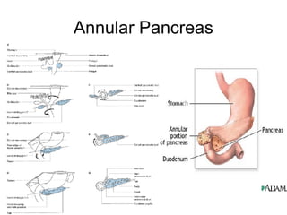 Annular Pancreas 