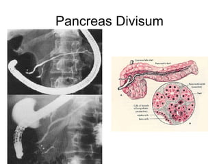 Pancreas Divisum 