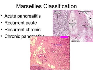 Marseilles Classification Acute pancreatitis Recurrent acute Recurrent chronic Chronic pancreatitis 