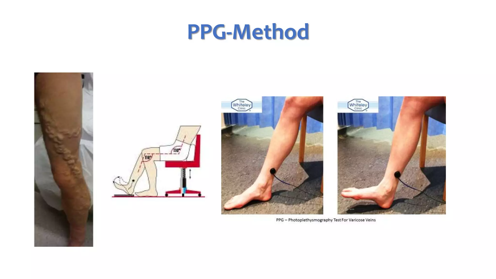 PPG and CDUS in venous reflux disease | PPTX