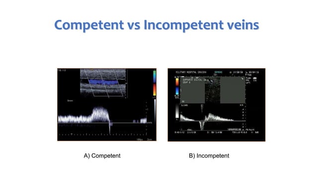 PPG and CDUS in venous reflux disease | PPTX