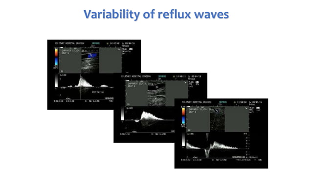 PPG and CDUS in venous reflux disease | PPTX