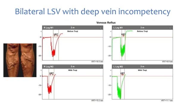 PPG and CDUS in venous reflux disease | PPTX