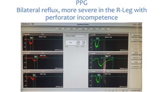 PPG and CDUS in venous reflux disease | PPTX