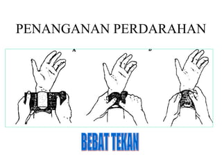 PENANGANAN PERDARAHAN BEBAT TEKAN 