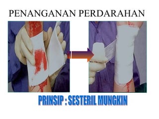 PENANGANAN PERDARAHAN PRINSIP : SESTERIL MUNGKIN 