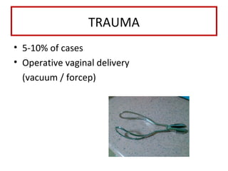 TRAUMA
• 5-10% of cases
• Operative vaginal delivery
(vacuum / forcep)
 