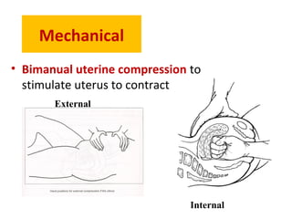 Mechanical
• Bimanual uterine compression to
stimulate uterus to contract
External
Internal
 
