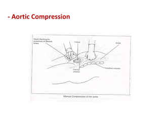 - Aortic Compression
 
