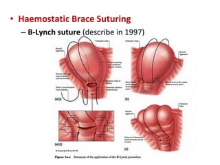 • Haemostatic Brace Suturing
– B-Lynch suture (describe in 1997)
 