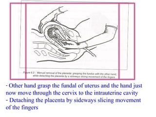 - Other hand grasp the fundal of uterus and the hand just
now move through the cervix to the intrauterine cavity
- Detaching the placenta by sideways slicing movement
of the fingers
 