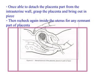 - Once able to detach the placenta part from the
intrauterine wall, grasp the placenta and bring out in
piece
- Then recheck again inside the uterus for any remnant
part of placenta
 