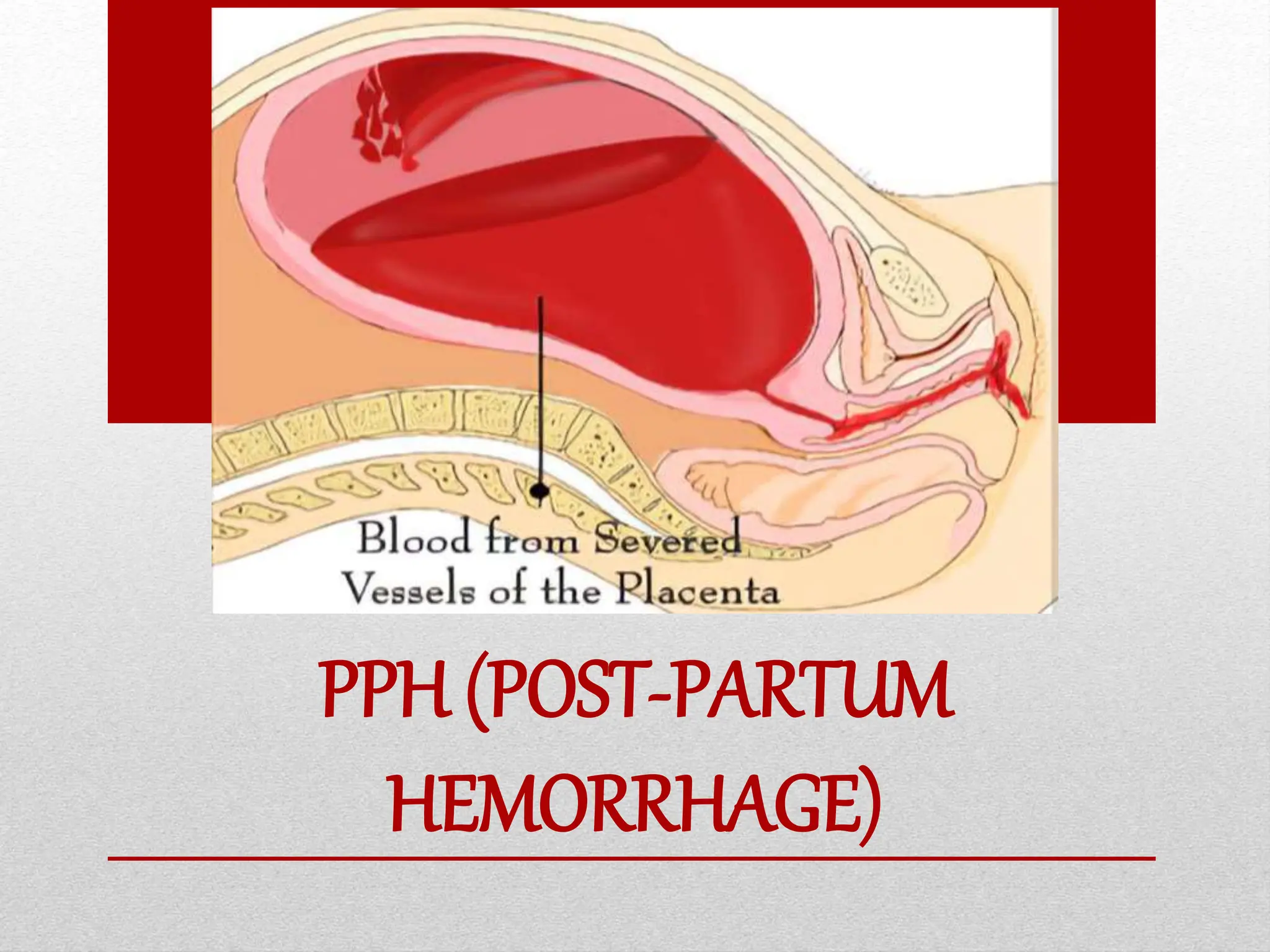 POST PARTUM HEMORRHAGE PPH POST PERTUM DELIVERY | PPTX