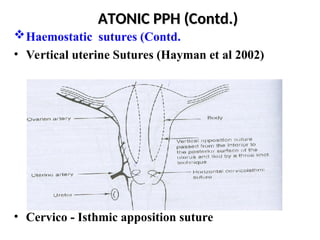 Post-partum haemorrhage Obstetrics and Gynecology.ppt