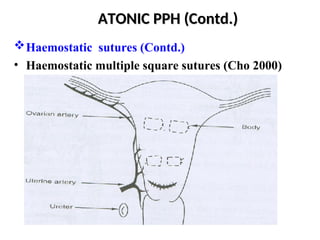 Post-partum haemorrhage Obstetrics and Gynecology.ppt