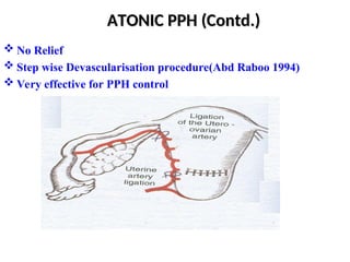 Post-partum haemorrhage Obstetrics and Gynecology.ppt