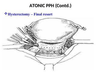 Post-partum haemorrhage Obstetrics and Gynecology.ppt