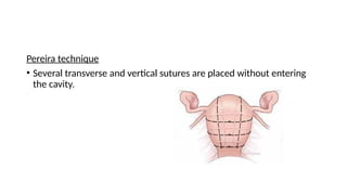 Pereira technique
• Several transverse and vertical sutures are placed without entering
the cavity.
 