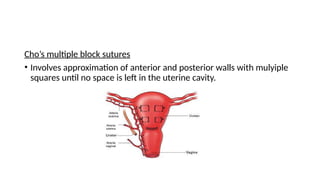 Cho’s multiple block sutures
• Involves approximation of anterior and posterior walls with mulyiple
squares until no space is left in the uterine cavity.
 
