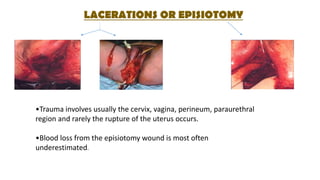 LACERATIONS OR EPISIOTOMY
•Trauma involves usually the cervix, vagina, perineum, paraurethral
region and rarely the rupture of the uterus occurs.
•Blood loss from the episiotomy wound is most often
underestimated.
 