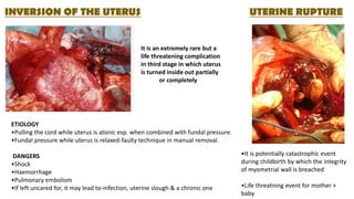 INVERSION OF THE UTERUS
It is an extremely rare but a
life threatening complication
in third stage in which uterus
is turned inside out partially
or completely
ETIOLOGY
•Pulling the cord while uterus is atonic esp. when combined with fundal pressure.
•Fundal pressure while uterus is relaxed-faulty technique in manual removal.
DANGERS
•Shock
•Haemorrhage
•Pulmonary embolism
•If left uncared for, it may lead to-infection, uterine slough & a chronic one
UTERINE RUPTURE
•It is potentially catastrophic event
during childbirth by which the integrity
of myometrial wall is breached
•Life threatning event for mother +
baby
 