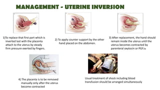 MANAGEMENT - UTERINE INVERSION
1)To replace that first part which is
inverted last with the placenta
attach to the uterus by steady
firm pressure exerted by fingers.
2) To apply counter support by the other
hand placed on the abdomen.
3) After replacement, the hand should
remain inside the uterus until the
uterus becomes contracted by
parenteral oxytocin or PGF2α
4) The placenta is to be removed
manually only after the uterus
become contracted
Usual treatment of shock including blood
transfusion should be arranged simultaneously
 