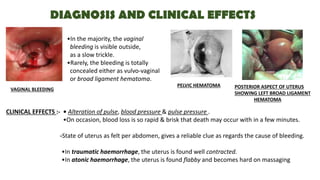 DIAGNOSIS AND CLINICAL EFFECTS
PELVIC HEMATOMA POSTERIOR ASPECT OF UTERUS
SHOWING LEFT BROAD LIGAMENT
HEMATOMA
VAGINAL BLEEDING
•In the majority, the vaginal
bleeding is visible outside,
as a slow trickle.
•Rarely, the bleeding is totally
concealed either as vulvo-vaginal
or broad ligament hematoma.
CLINICAL EFFECTS :- • Alteration of pulse, blood pressure & pulse pressure .
•On occasion, blood loss is so rapid & brisk that death may occur with in a few minutes.
-State of uterus as felt per abdomen, gives a reliable clue as regards the cause of bleeding.
•In traumatic haemorrhage, the uterus is found well contracted.
•In atonic haemorrhage, the uterus is found flabby and becomes hard on massaging
 