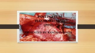 POSTPARTUM
HAEMORRHAGE
(PPH)
PRESENTED BY: KANCHAN SINGH
 