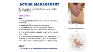 ACTUAL MANAGEMENT
The first step is to control the fundus and to note the
feel of the uterus.
ATONIC UTERUS
Step 1 :
a) Massage the uterus to make it hard and express the
blood clot.
b) Methegrin 0.2mg is given intravenously.
c) Inj oxytocin drip is started (10 units in 500ml of
normal saline) at the rate of 40-60 drops per minute.
d) Foley catheter to keep bladder empty and to monitor
urine output.
e) To examine the expelled placenta and membranes , for
evidence of missing cotyledon or piece of membranes .
If the uterus fails to contract, proceed to the next step.
Step 2 :
The uterus is to be explored under general anaesthesia.
MASSAGE THE FUNDUS
 