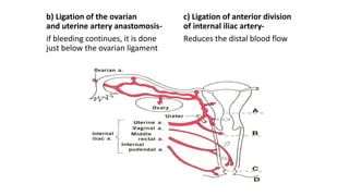 b) Ligation of the ovarian
and uterine artery anastomosis-
if bleeding continues, it is done
just below the ovarian ligament
c) Ligation of anterior division
of internal iliac artery-
Reduces the distal blood flow
 