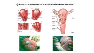d) B-Lynch compression suture and multiple square sutures-
 