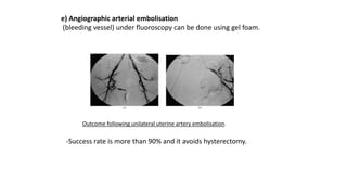 e) Angiographic arterial embolisation
(bleeding vessel) under fluoroscopy can be done using gel foam.
Outcome following unilateral uterine artery embolisation
-Success rate is more than 90% and it avoids hysterectomy.
 
