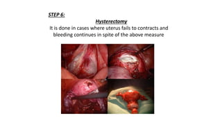 STEP 6:
Hysterectomy
It is done in cases where uterus fails to contracts and
bleeding continues in spite of the above measure
 